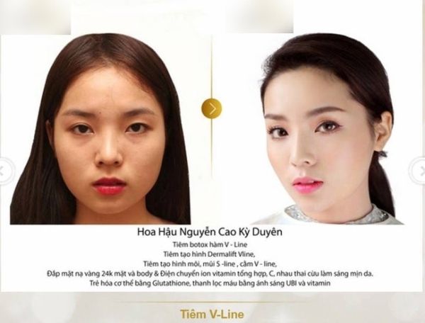 Hoa hậu Kì Duyên "mất điểm" vì tin đồn lạm dụng botox để làm đẹp.