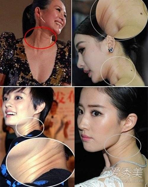 Chương Tử Di, Lưu Diệc Phi và Tôn Lệ cũng bị ảnh hưởng bởi vùng da nhăn nheo vùng cổ. Ixiumei cho rằng những hình ảnh này khiến các sao như già đi cả chục tuổi.