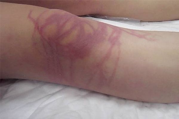 Vết sứa cắn chằng chịt trên người nạn nhân, các chất độc có thể gây ức chế hoạt động tim mạch và thần kinh dẫn đến tử vong.