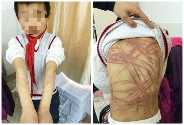 Cô giáo đã chụp ảnh những vết thương này và đăng tải trên mạng.