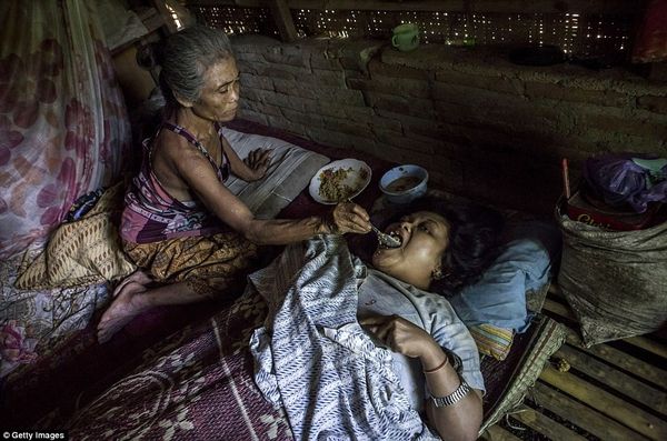Sijum, 40 tuổi bị hội chứng Down đang nằm bất động trên giường chờ mẹ đút cho ăn