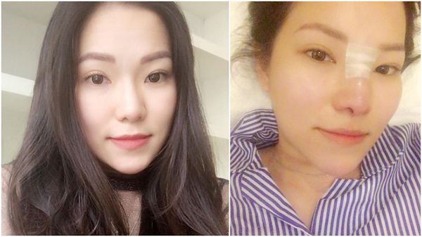 Lộ ảnh vợ cũ Lâm Vinh Hải phẫu thuật mũi và tiêm môi Lộ ảnh vợ cũ Lâm Vinh Hải phẫu thuật mũi và tiêm môi
