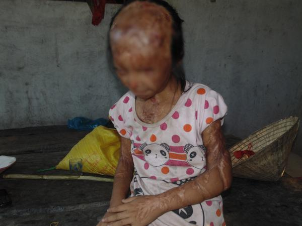 Cuộc sống mù lòa của cô bé 12 tuổi sau 5 năm hứng trọn can a xít trong trận đánh ghen kinh hoàng - Ảnh 2.
