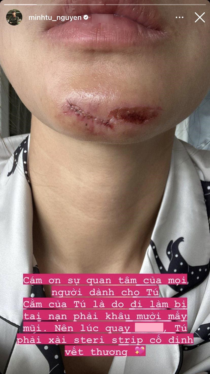  Minh Tú tiếp tục gây lo lắng hậu bị tai nạn phải khâu hơn 10 mũi: Hết cằm lại tới mắt! Ảnh 2